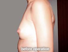 plastic-surgery-breast-augmentation 